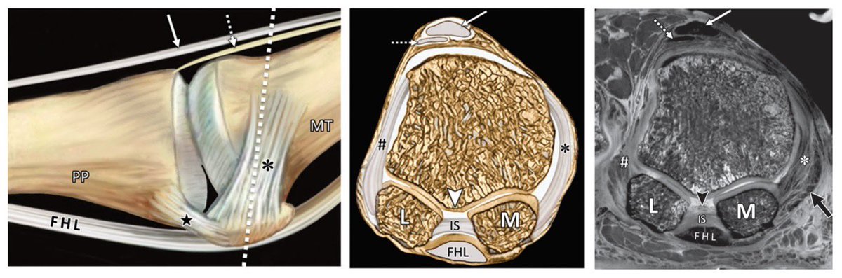 dflemosmd's tweet photo. Fresh out of the oven...a gorgeous @RadioGraphics article with beautiful drawings, dissections, and high res MR images of the 1st MTP Joint...congrats to Jim Hallinan, @mskbradiologist @CBChung_ucsd and other coauthors @UCSDImaging #mskrad a “must” read https://t.co/4cVtqRgWrs https://t.co/o6pQVDMvjw