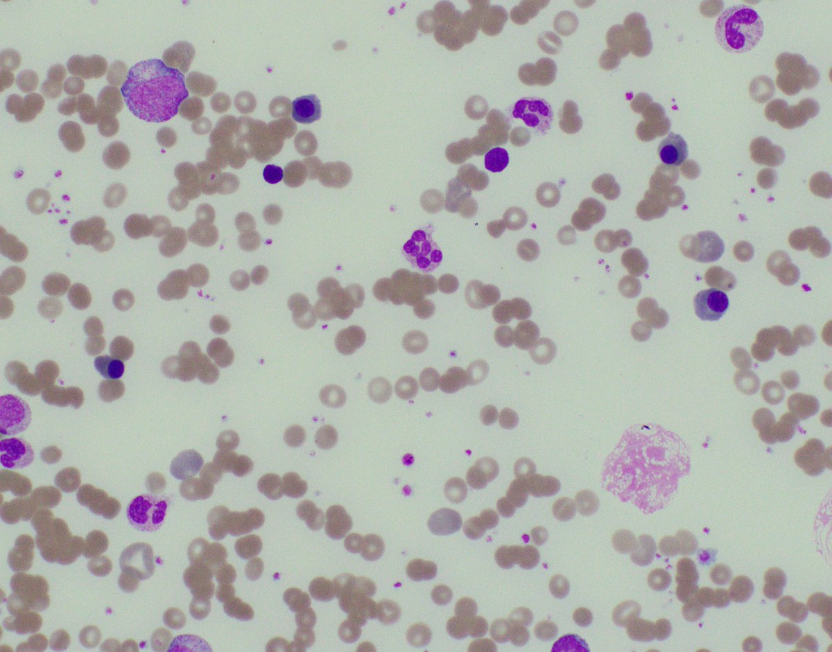 COVID-associated Kawasaki-like disease on a PB smear: leukoerythroblastosis with plasmacytoid lymphocytes.  WBC >40K #COVID19 #PIMSTS