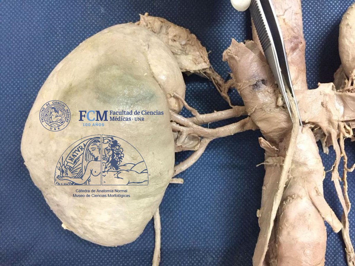 anatomiafcmunr's tweet photo. 💀DISECCIÓN CADAVÉRICA ‼️ Se visualizan riñones con uréteres, glándulas suprarrenales, vena cava inferior y aorta abdominal. Gran trabajo de nuestro equipo del Museo💀 https://t.co/ainrZDTRBQ