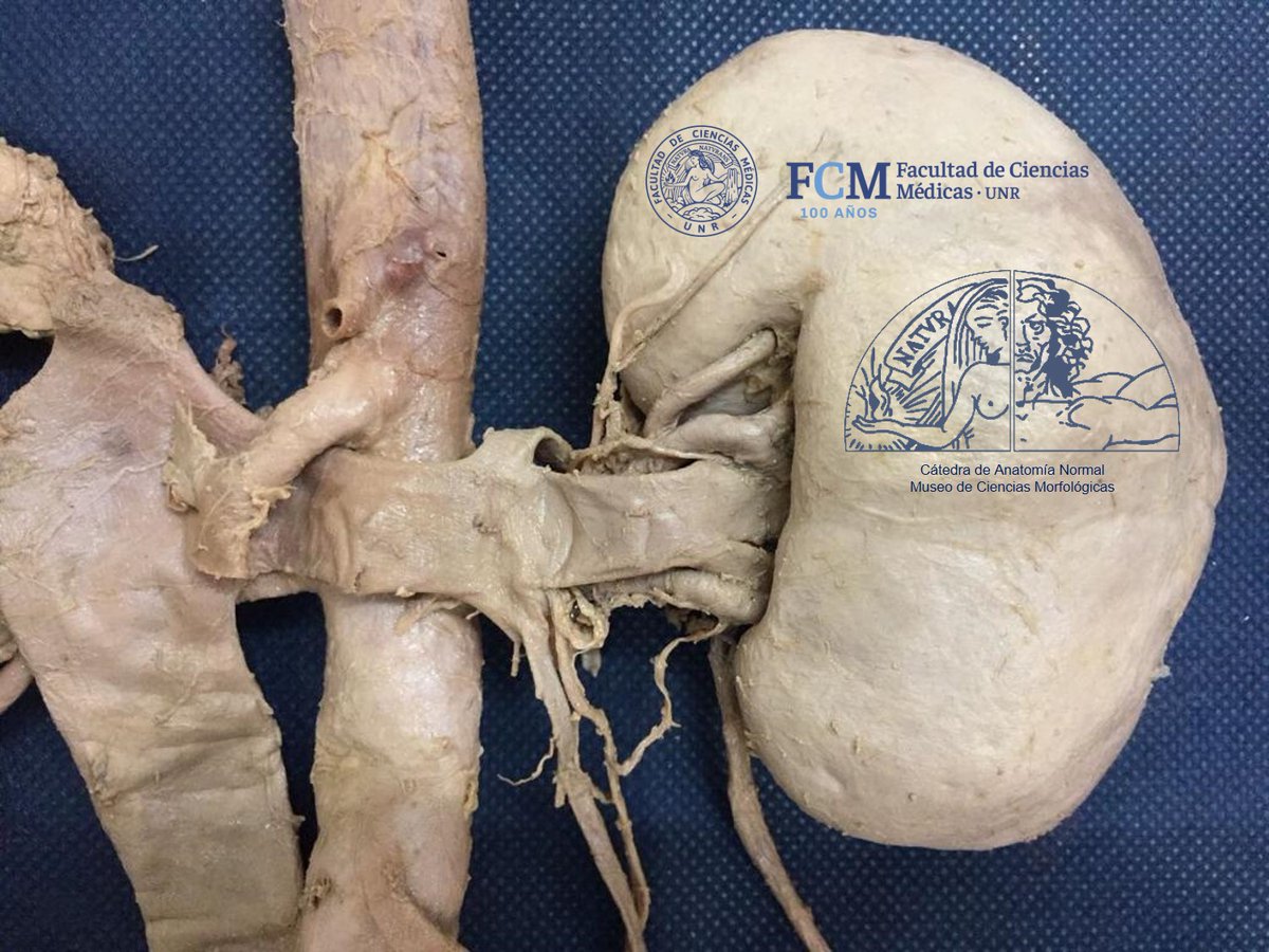 anatomiafcmunr's tweet photo. 💀DISECCIÓN CADAVÉRICA ‼️ Se visualizan riñones con uréteres, glándulas suprarrenales, vena cava inferior y aorta abdominal. Gran trabajo de nuestro equipo del Museo💀 https://t.co/ainrZDTRBQ