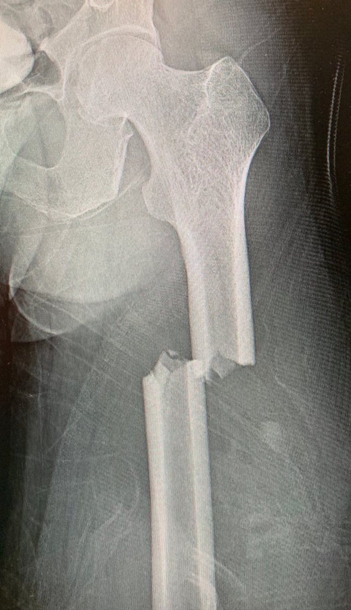 Chubbyemu On Twitter A Boy Ate 150 Gummy Vitamins For Breakfast This Is What Happened To His Bones