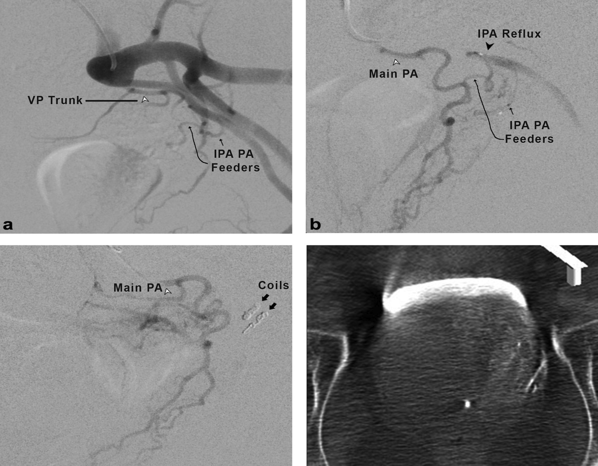 jdemeritt's tweet photo. Avoid complications, communicating proximal IPA collaterals are not to be missed when performing #PAE, Type 2 central gland blood supply! 

https://t.co/GIqWbWUdfA https://t.co/b1qjXe1DEZ