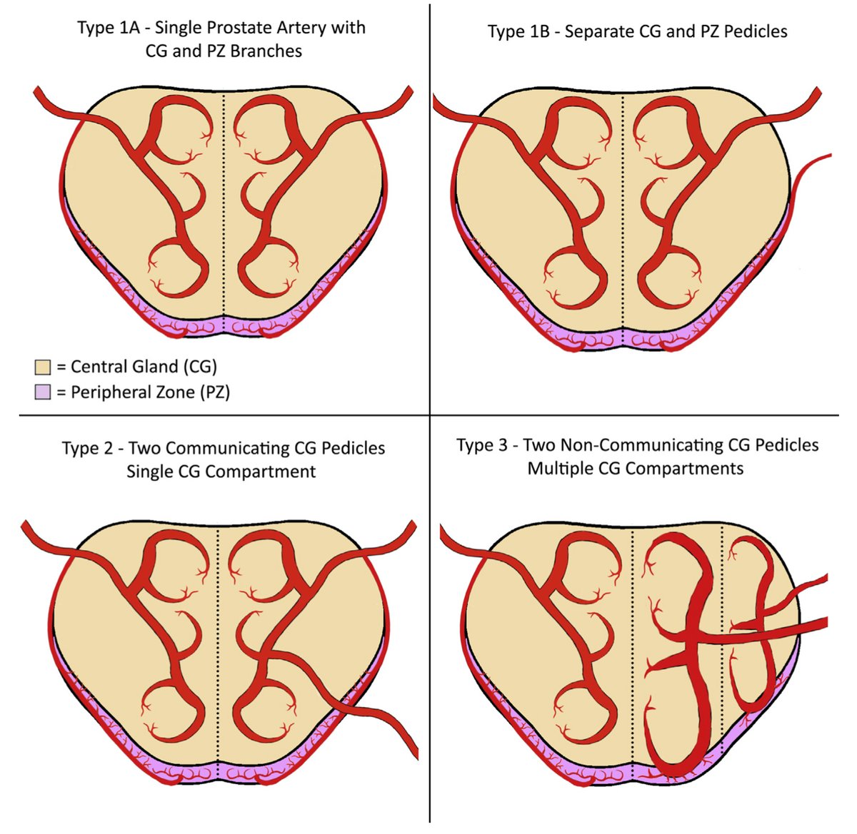 jdemeritt's tweet photo. Avoid complications, communicating proximal IPA collaterals are not to be missed when performing #PAE, Type 2 central gland blood supply! 

https://t.co/GIqWbWUdfA https://t.co/b1qjXe1DEZ