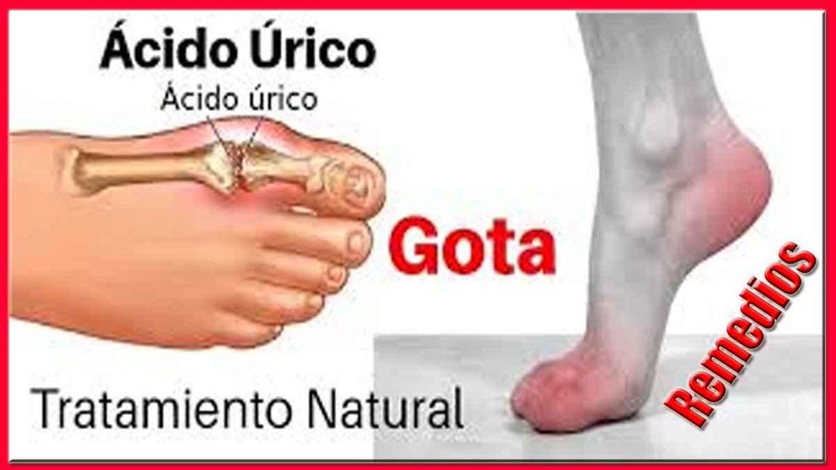 Remedios caseros para el ácido úrico/Como Bajar El Ácido Úrico Rápido youtu.be/PBoEcR1IoHg vía <a href="/YouTube/">YouTube</a>