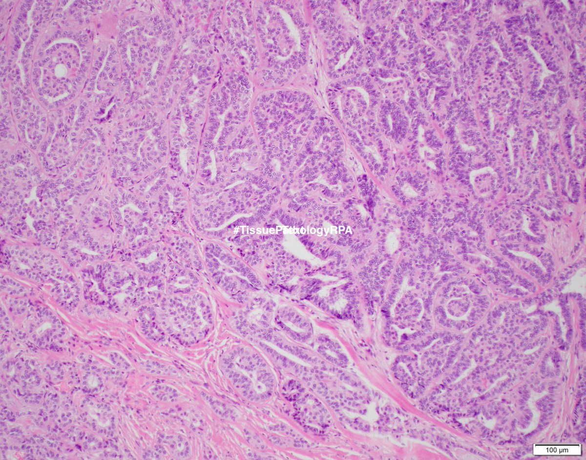 60/F Nodule at the junction of hard and soft palate.#TissuePathologyRPA #ENTpath polymorphous architecture with solid, cribriform and papilliform patterns. Uniform nuclei: Polymorphous adenocarcinoma <a href="/ProsserNj/">NJ Prosser</a> <a href="/SameeraAnsar2/">Sameera Ansar</a> <a href="/Leili01146780/">LMA</a> @DrZaborowski