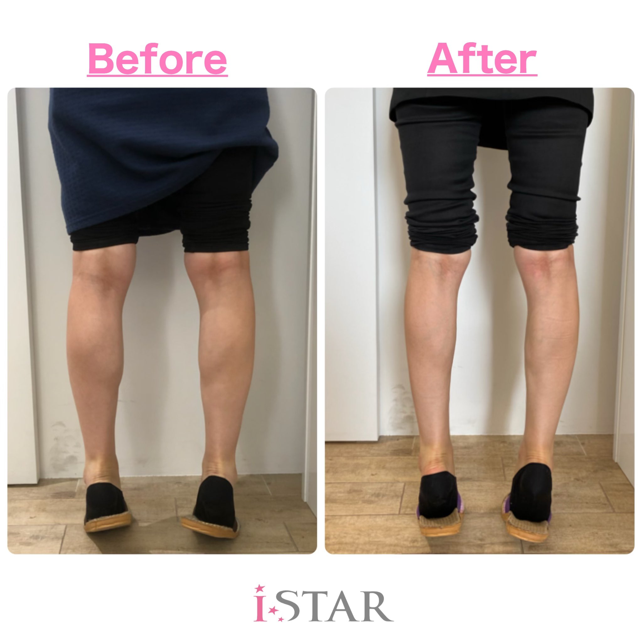 Istar整形外科 皮膚科 ししゃも足の方 脚がゴツゴツして見える方 太さが左右非対称の方 注目 ふくらはぎボトックスでスッキリ美脚を目指しませんか 施術は簡単でダウンタイムもなしです 気になる方はお問い合わせ下さいませ Line Joh29b