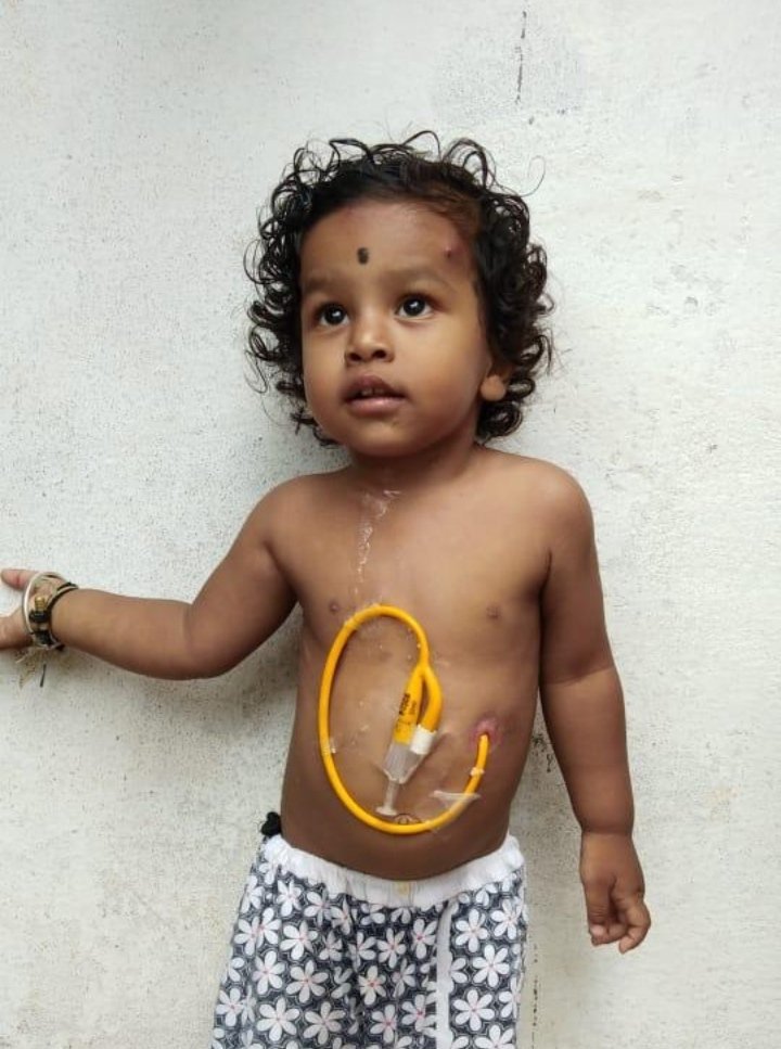 ReddySandeep19's tweet image. @KTRTRS Sir, #Mokshith has been having trouble with the #GastroProblem since birth. A year ago, Yashoda underwent surgery at the Secunderabad Hospital. Then it became almost 20 lakhs. Now we need another 12.40 lakhs. Please help sir.
Father name : A Mahesh 9000589559 From Gajwel.