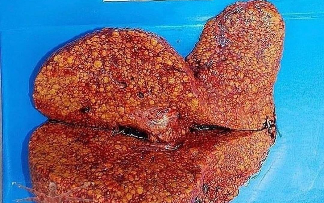aproko_doctor's tweet photo. Picture 1 Healthy liver
Picture 2. Liver damaged by alcohol, replacing the healthy tissue with useless tissue. If you have too much useless tissue, it can lead to liver failure

Do you know that alcohol can also cause hepatitis?

An overdose of paracetamol can damage your liver https://t.co/NoejaCet9T