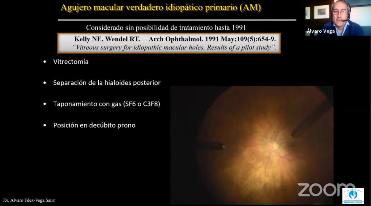 RetinaSERV's tweet photo. Tratamiento de agujeros maculares refractarios con plasma rico en factores de crecimiento.
Alvaro Fernández-Vega
#SERVIRTUAL https://t.co/z1yuN8npaa