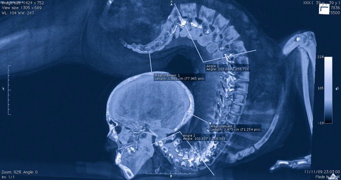OrthopodReg's tweet photo. Image of a contortionist

It’s looking likely my first job on return to training in April 2021 may be spines

My diagnosis here is “not right”

#orthotwitter #Neurosurgery #spine #MedEd https://t.co/ZMgXcXUO6Z