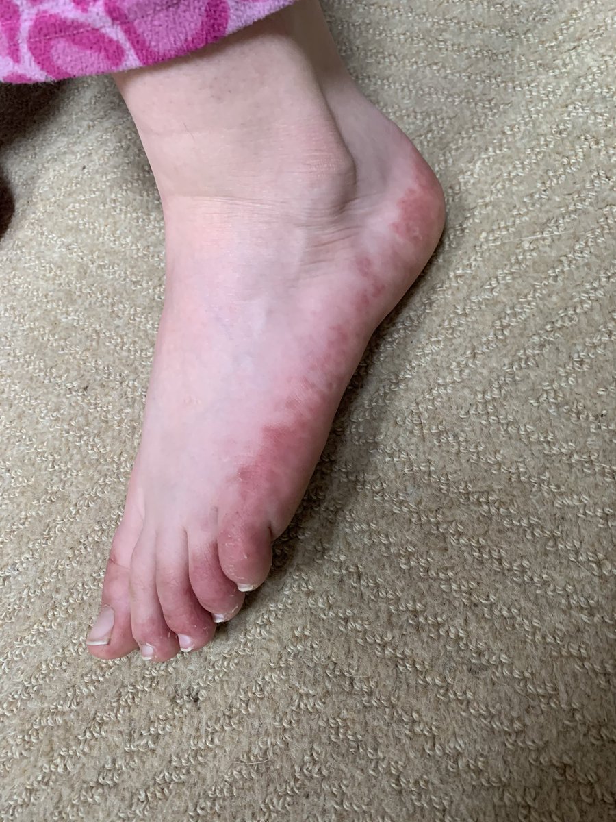  #covidtoes  #toevid update. This is 40 days after she first complained of feet symptoms and 91 days after first symptoms of a febrile URI (might have been something other than COVID, it was early). No swelling, itching or pain for about...2 weeks now.