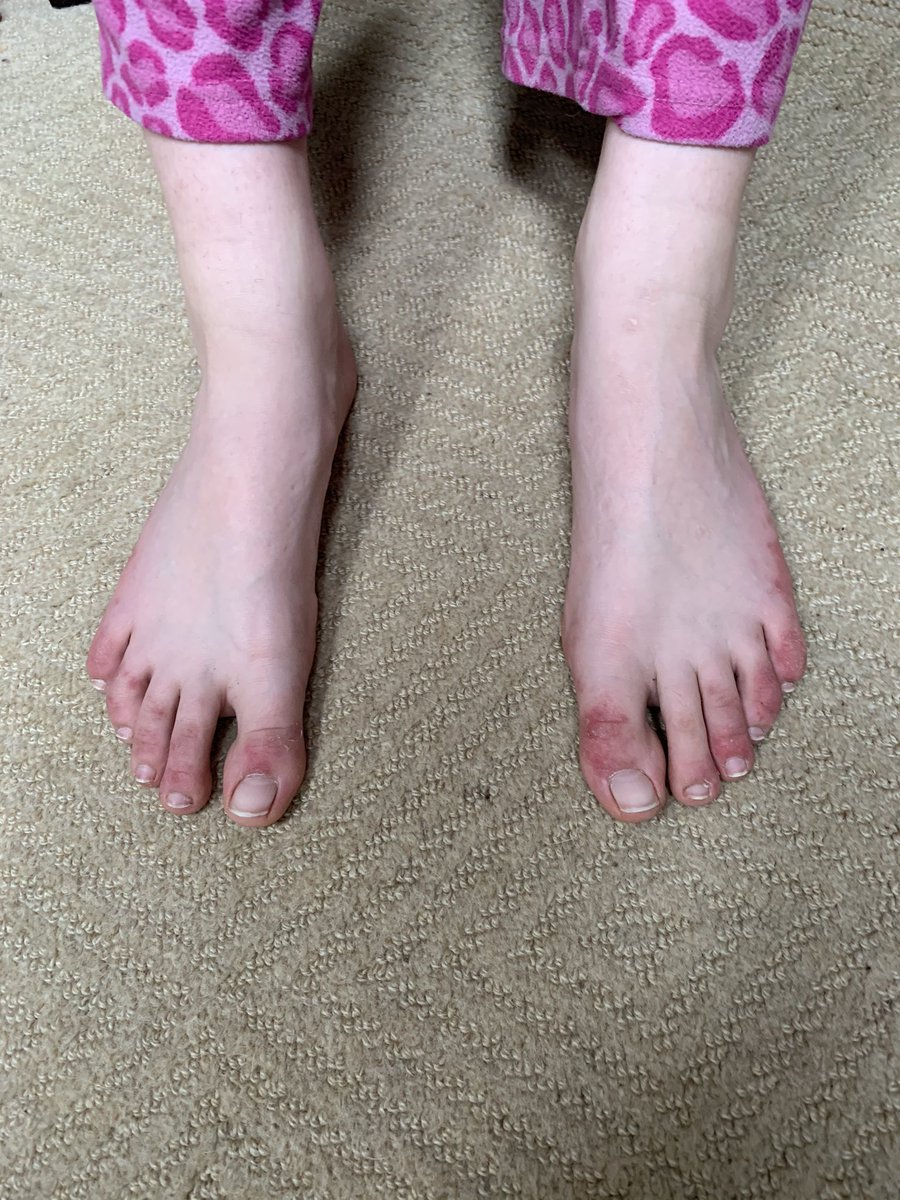  #covidtoes  #toevid update. This is 40 days after she first complained of feet symptoms and 91 days after first symptoms of a febrile URI (might have been something other than COVID, it was early). No swelling, itching or pain for about...2 weeks now.