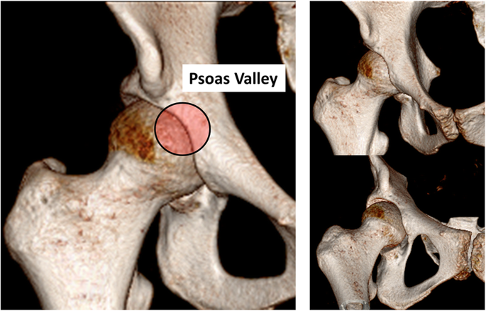 Vikas Khanduja (@cambridgehipdoc) on Twitter photo Anatomy of the psoas valley unraveled! Read our recent publication rdcu.be/b4dMd to answer:
1. What is the definition of the psoas valley?
2. What are its dimensions i.e. depth, width, shape and location?
3. What are the factors which influence its anatomy?
<a href="/BMC_series/">BMC Series</a> Anatomy of the psoas valley unraveled! Read our recent publication rdcu.be/b4dMd to answer:
1. What is the definition of the psoas valley?
2. What are its dimensions i.e. depth, width, shape and location?
3. What are the factors which influence its anatomy?
<a href="/BMC_series/">BMC Series</a>