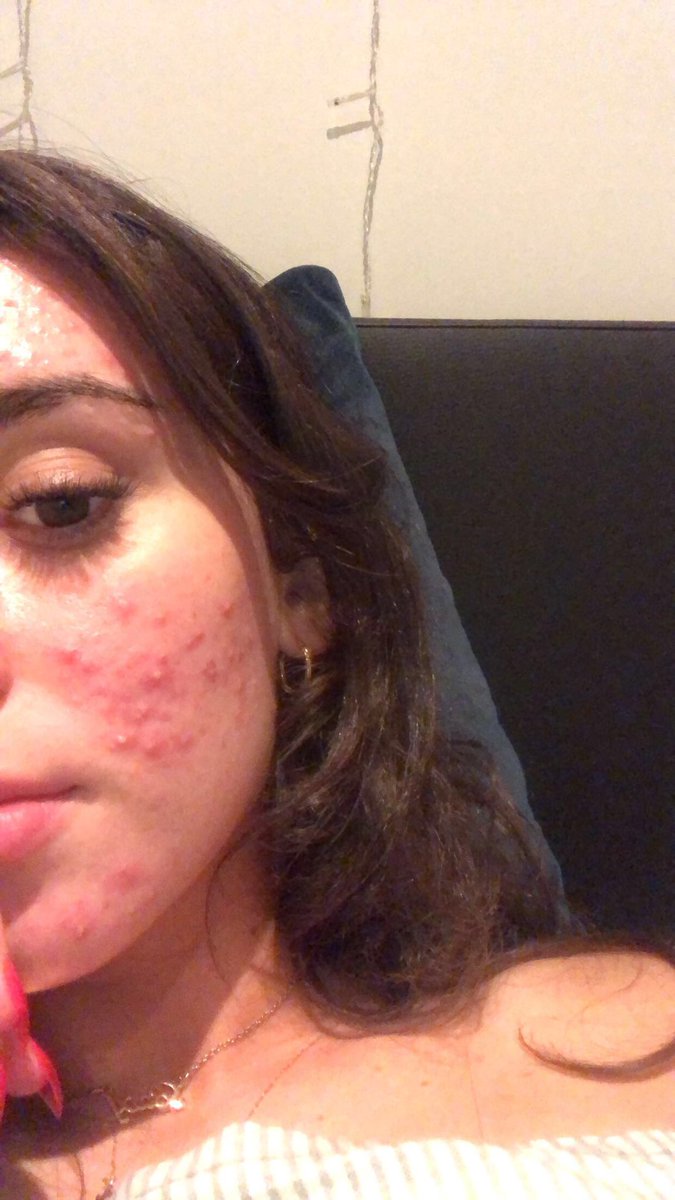 laurjefferies1's tweet photo. i know there’s more important things in the world but i can’t believe how much better my skin has got in the past 8/9 months ! it’s crazy how much the pill can effect u 🤍 https://t.co/KPMJnIlkpg