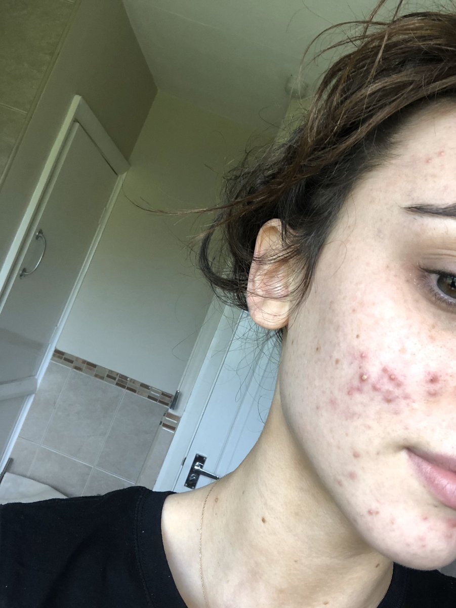 laurjefferies1's tweet photo. i know there’s more important things in the world but i can’t believe how much better my skin has got in the past 8/9 months ! it’s crazy how much the pill can effect u 🤍 https://t.co/KPMJnIlkpg