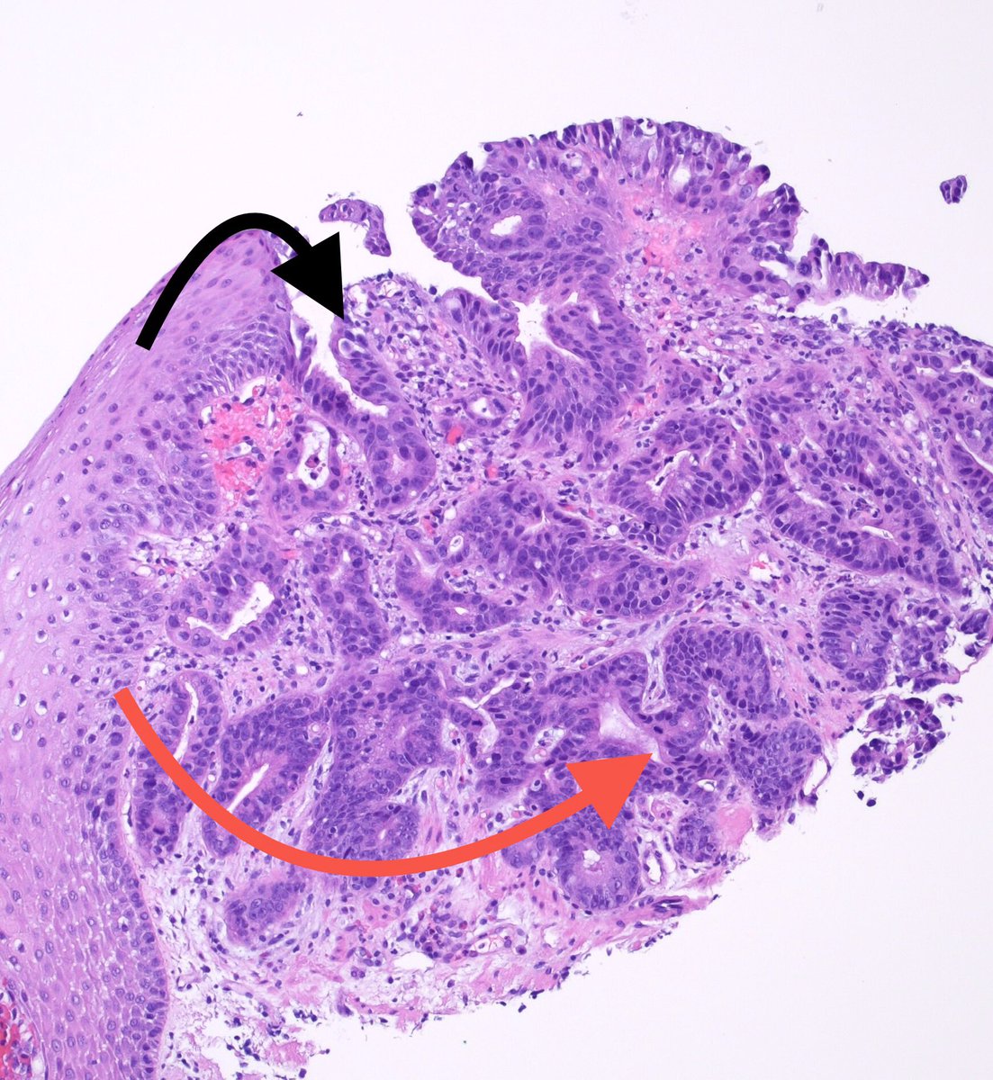 But to me those complex irregular glands deeper in the mucosa & slightly odd (?desmoplastic) stroma were bad ju-ju (red arrow)
