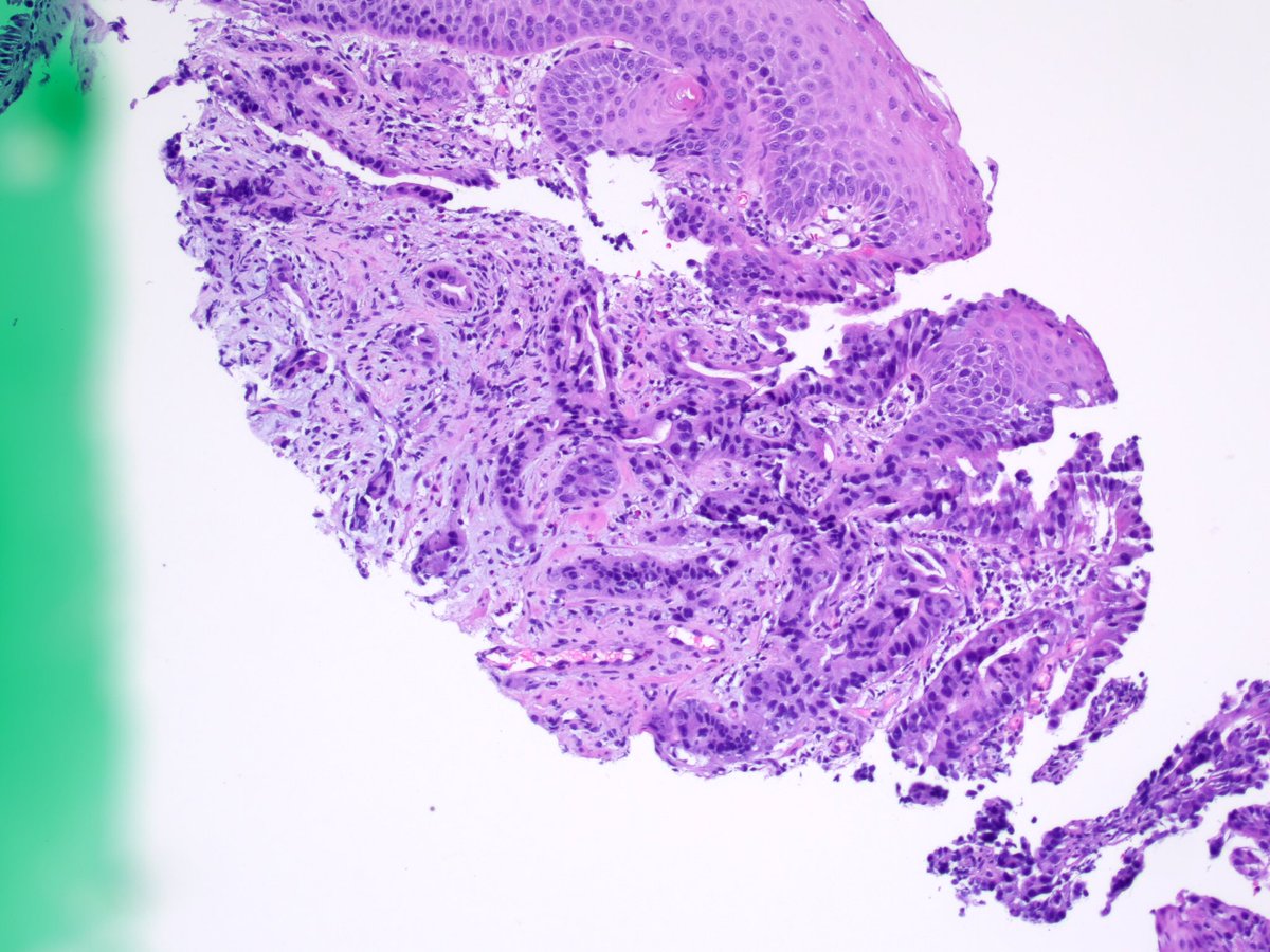 I leveled it (pics shown)Dx on consultation: adenocarcinoma, at least intramucosal. Lesson 1: easy to get caught up looking at maturation (which is important), don’t forget to look at the baseLesson 2: get levels if considering dysplasia!!