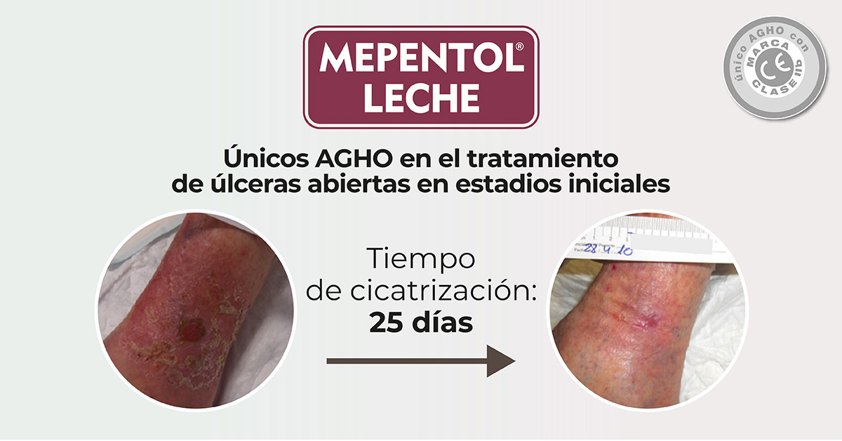 ULCERAS.NET on X: MEPENTOL y MEPENTOL LECHE son los únicos AGHO con  evidencias en el tratamiento de úlceras abiertas en estadios iniciales -  Visita nuestra web  - #Alfasigma #Mepentol #Mepentol  Leche