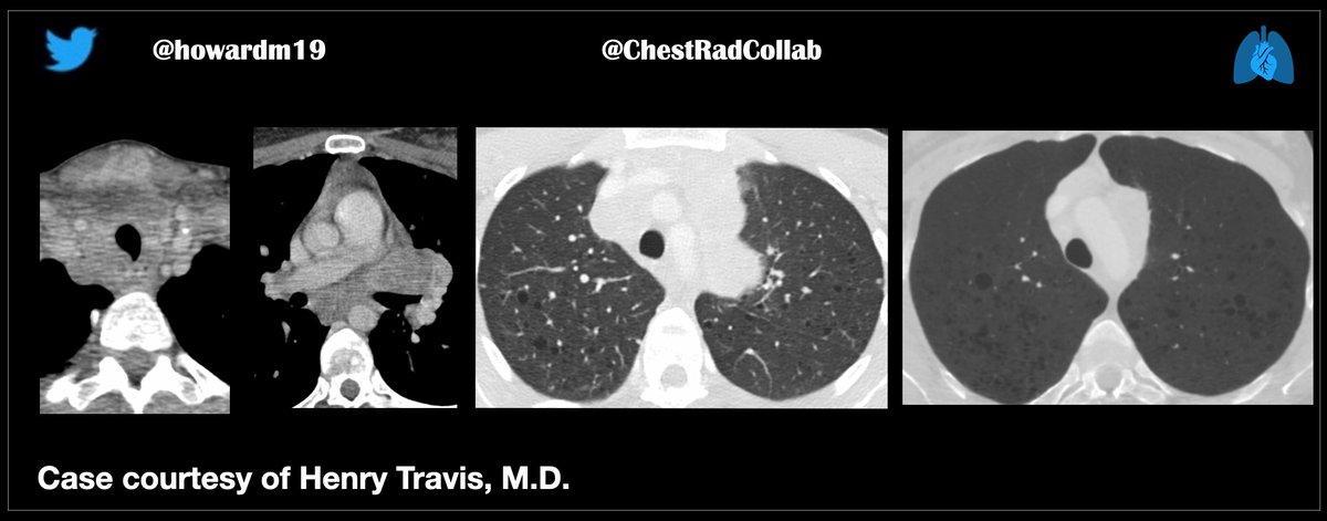 chestradcollab's tweet photo. @DrTravisScott @6Patterns 
Case shown at STR Webinar. Clinical information withheld.
There is really no Differential Diagnosis.

#ChestRadEd #FOAMrad https://t.co/bIu7MChifm