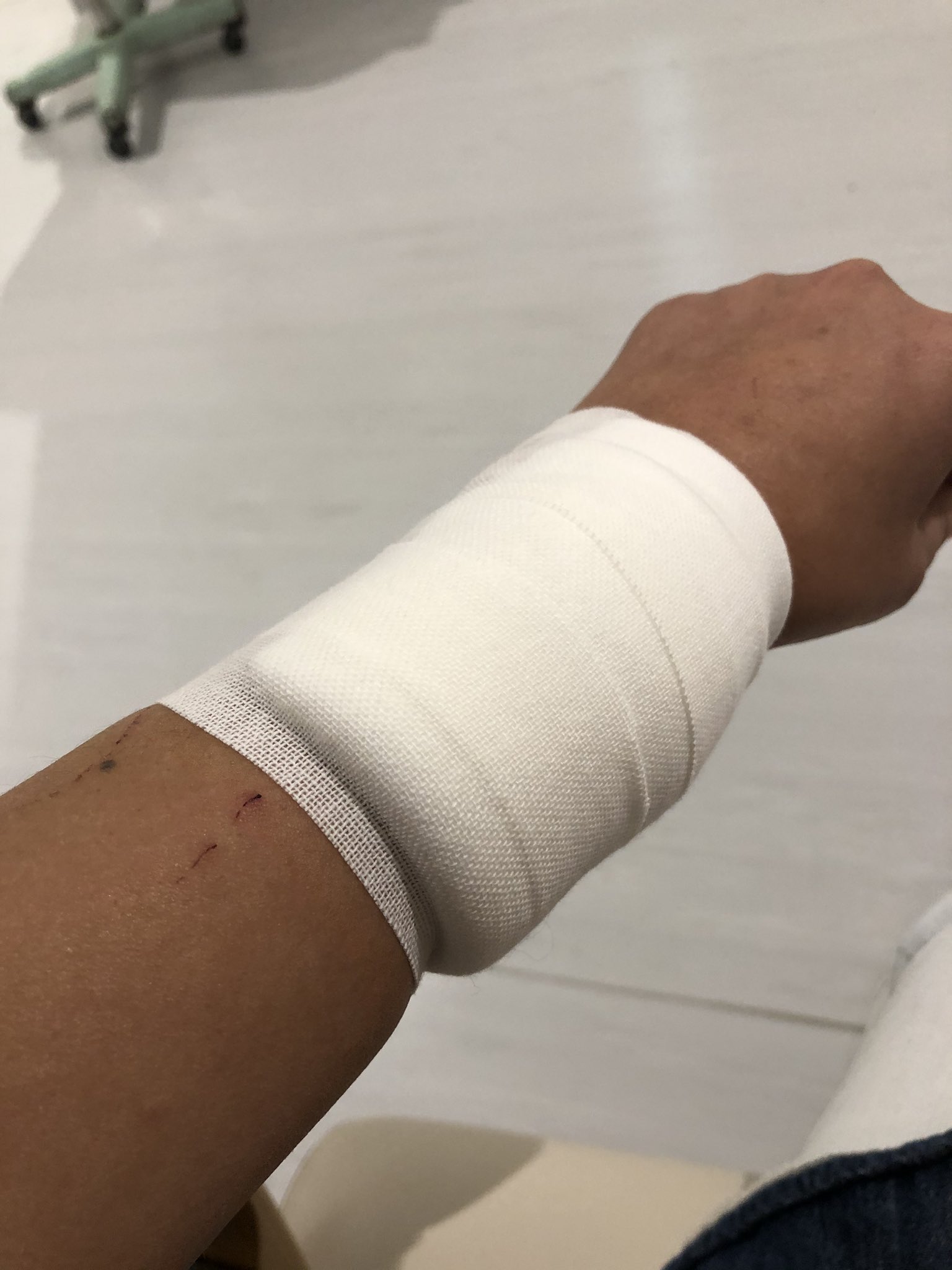 おたくま経済新聞 猫に噛まれたらどうなる みたいなツイをみかけたので どうなるか置いときますね 室内飼の猫に噛まれる 直ぐ傷口が腫れる 病院で傷口切開の上 奥までしっかり消毒 破傷風の注射うたれる 計3回必要 写真は2月に撮影 その後2回目