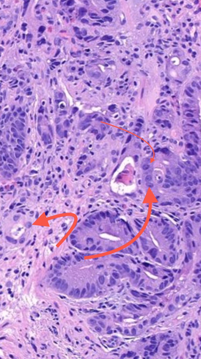 Note intraluminal necrosis (black arrow), small angulated glands (blue arrows), focal open nuclei with prominent nucleoli (red arrows). These all suggest a transition from dysplasia to invasion.