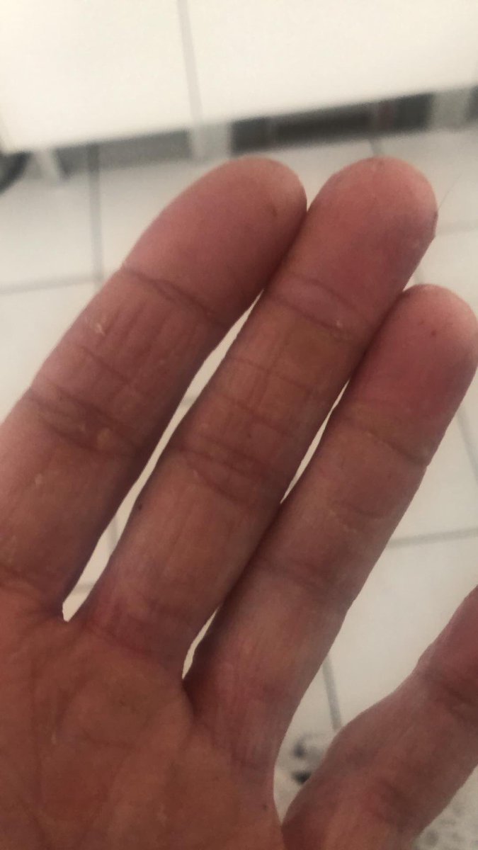 My hands one week apart!! All the handwashing has really affected my hands so a week off work amd lots of healing! Can’t recommend manuka honey dressings enough, lifesaver for your hands if you are suffering!!
