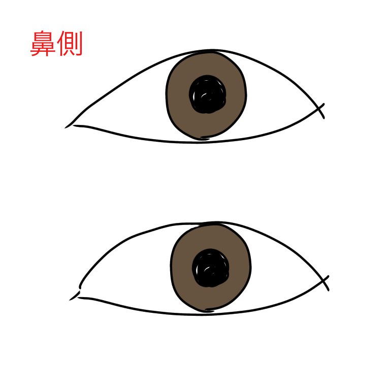 カワウソ 目の整形感って 二重幅の広さだけじゃなくて 目頭上の角度も大事だなって思う 目頭 上のカーブが小さくて斜面っぽくなってるとキツイ顔 整形感が強くなる 上 目頭上切開するとそのカーブを緩やかにできるのかな 優しい目になりそう 下