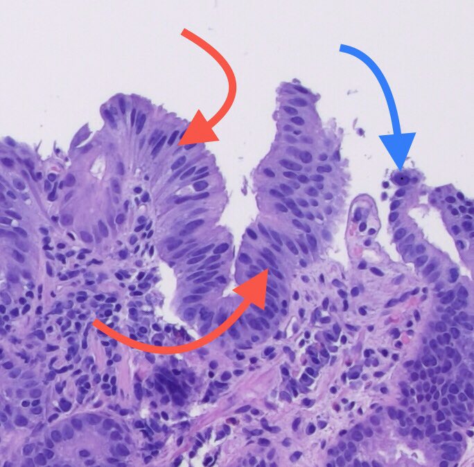 Is there dysplasia? Look at the red arrows here: base of this crypt looks similar to the surface (ie, lack of maturation). Four lines are not intact. See the blue arrow: some atypical hyperchromatic nuclei are present. Not much inflammation.