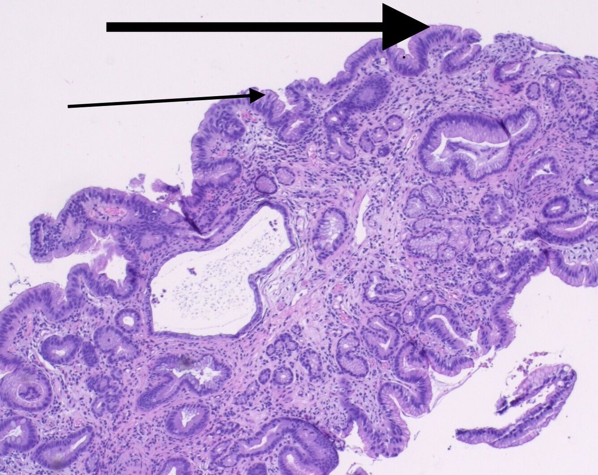 Note abundant foveolar type mucin (black arrows) + lack of goblet cells (at least this field, were present focally in other areas)