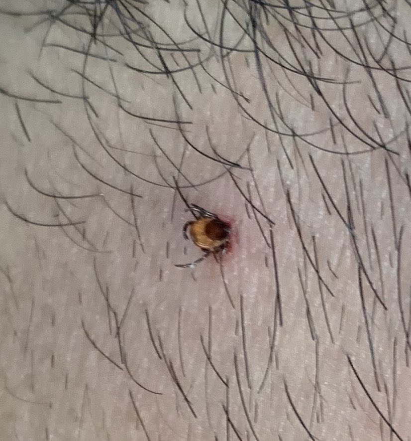 マダニに刺された時の注意点 Togetter