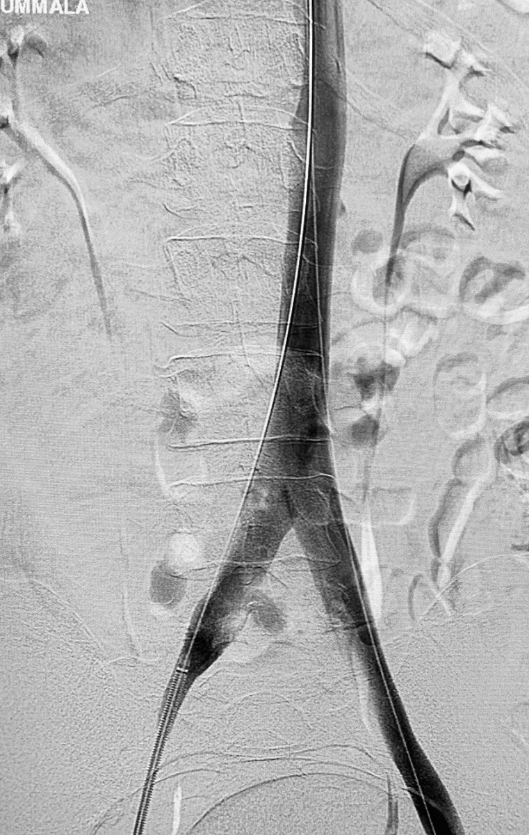 t_intheleadcoat's tweet photo. #IVCthrombus , L CIV thrombus Rx using @Medtronic #reliant balloon as protection while doing @InariMedical #clottriever.
NO TPA, NO ICU #singlesessionthrombectomy #thrombectomyfirst #irad @SIRspecialists @SIR_ECS @EVToday @JVIRmedia @CVIR_Journal @VenousNews @VenousSymposium https://t.co/oKXJKGJQLb