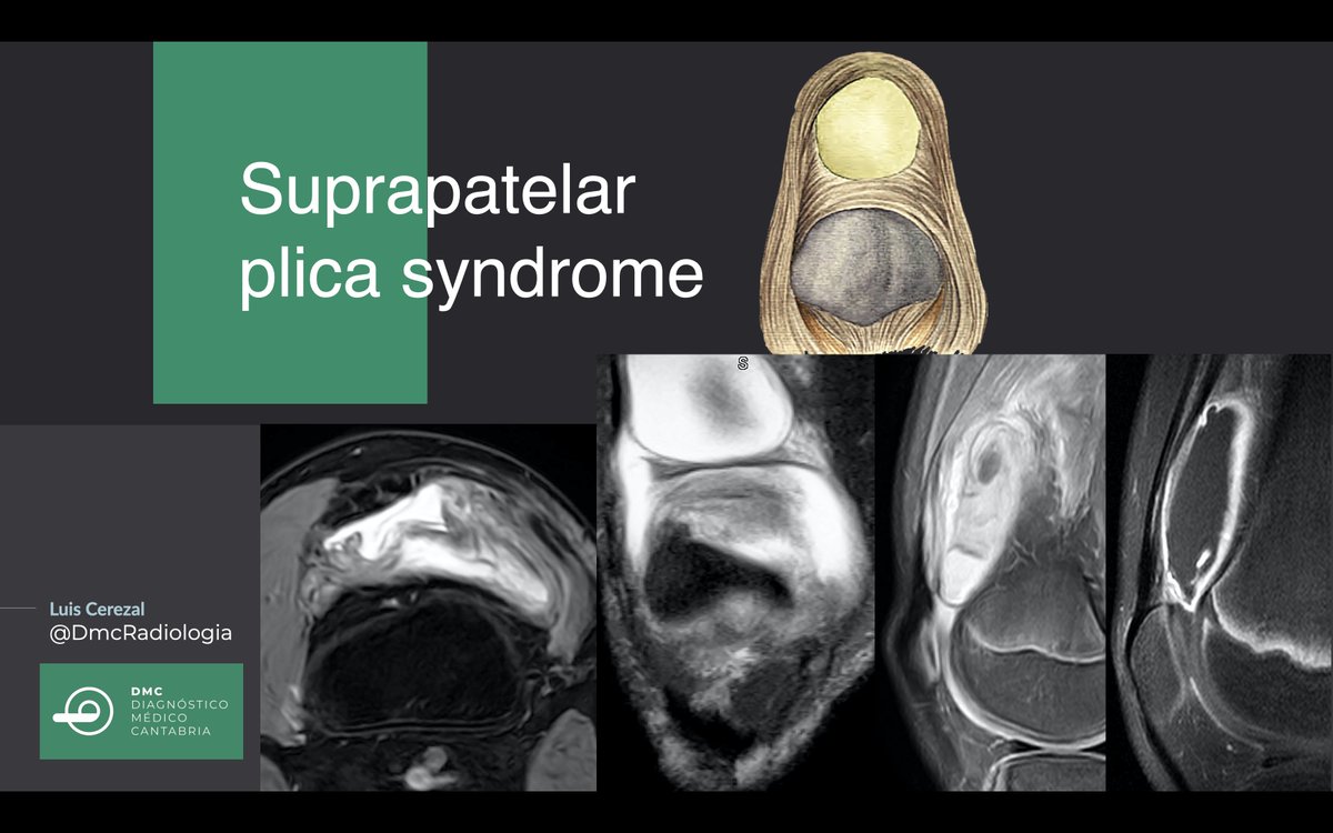 DmcRadiologia's tweet photo. A complete suprapatellar plica (septum completum) may isolate the suprapatellar pouch from the knee joint. Suprapatellar plica syndrome manifests clinically as chronic anterior knee pain and swelling. MRI shows a distended pouch with synovitis, debris, and fibrous bands https://t.co/6XZNiLW4Br