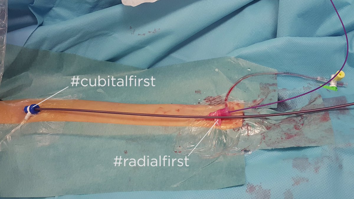 Marios Psychogios (@mpeyt1) on Twitter photo Any reason you still puncture the groin or neck when doing venous stuff? not really right? #cubitalfirst transvenous embolization of an ethmoidal dAVF, check our vid ==> youtu.be/oxtI7CoGhXQ <== <a href="/DrPatchiz/">Dr. Nathan Manning</a> <a href="/Fie0815/">Jens Fiehler</a> <a href="/mobilestroke4U/">Ryan A McTaggart MD</a> <a href="/braincutter/">Eric Peterson</a> @VladoKZg Any reason you still puncture the groin or neck when doing venous stuff? not really right? #cubitalfirst transvenous embolization of an ethmoidal dAVF, check our vid ==> youtu.be/oxtI7CoGhXQ <== <a href="/DrPatchiz/">Dr. Nathan Manning</a> <a href="/Fie0815/">Jens Fiehler</a> <a href="/mobilestroke4U/">Ryan A McTaggart MD</a> <a href="/braincutter/">Eric Peterson</a> @VladoKZg