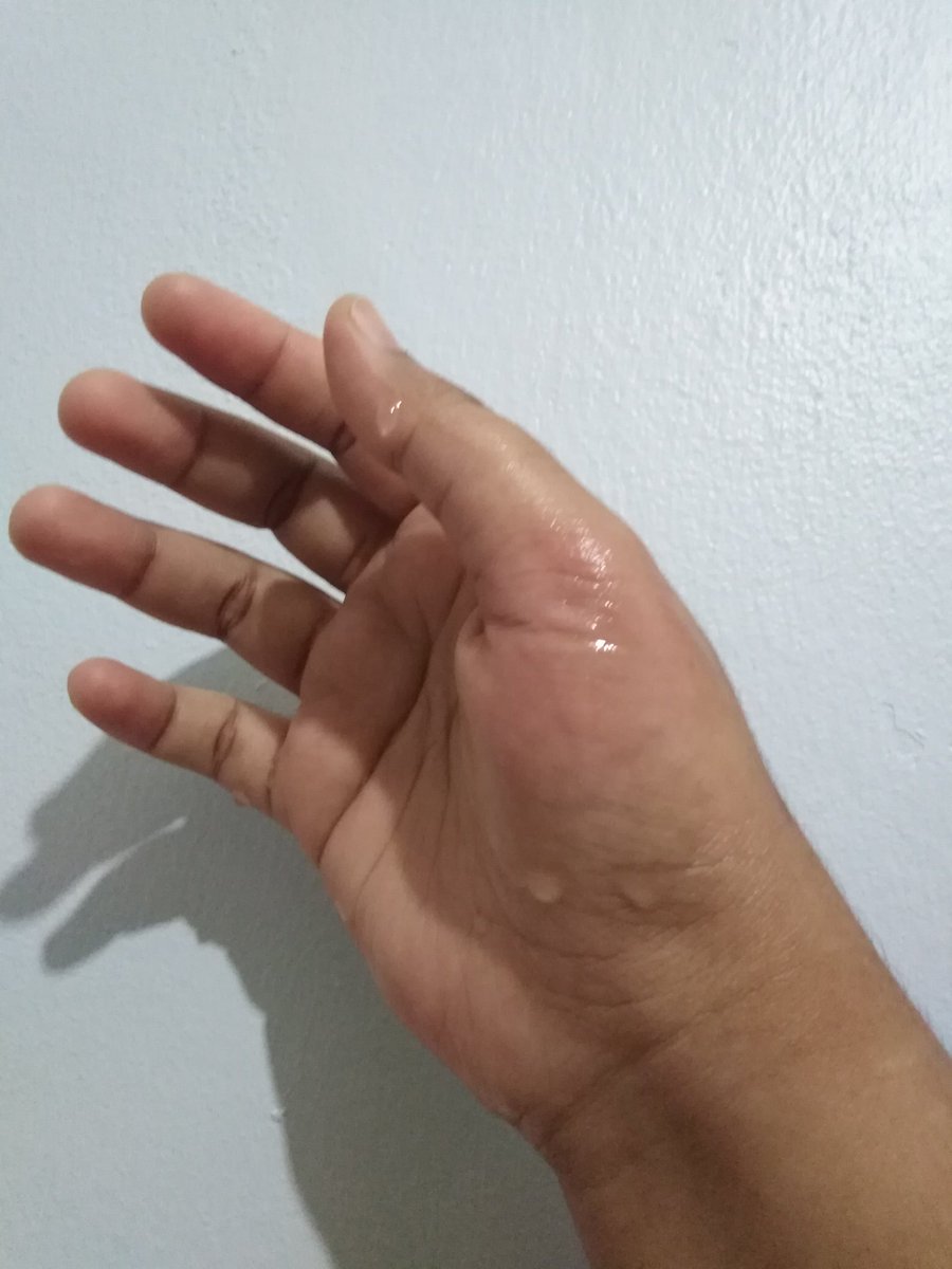 Dee Pa Twitter Kena Minyak Panas Goreng Nugget Tatsat Nmpk Mcm Biasa Tapi Rasa Pedih Tu Ya Robbi Https T Co Igwzeelxrr Twitter