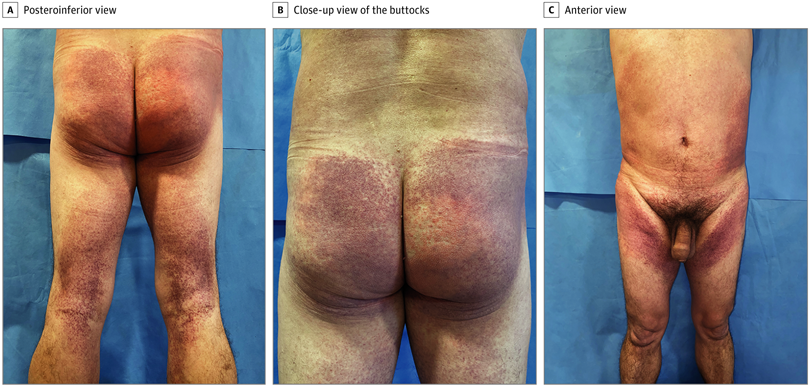 Edgar_Vi's tweet photo. Petechial Skin Rash Associated With Severe Acute Respiratory Syndrome Coronavirus 2 Infection.  Skin biopsy specimens from patients with this disease show a perivascular mononuclear inflammatory infiltrate, eosinophils, and extravasated erythrocytes. #Covid_19 #skincare https://t.co/gtYCGKlMZN
