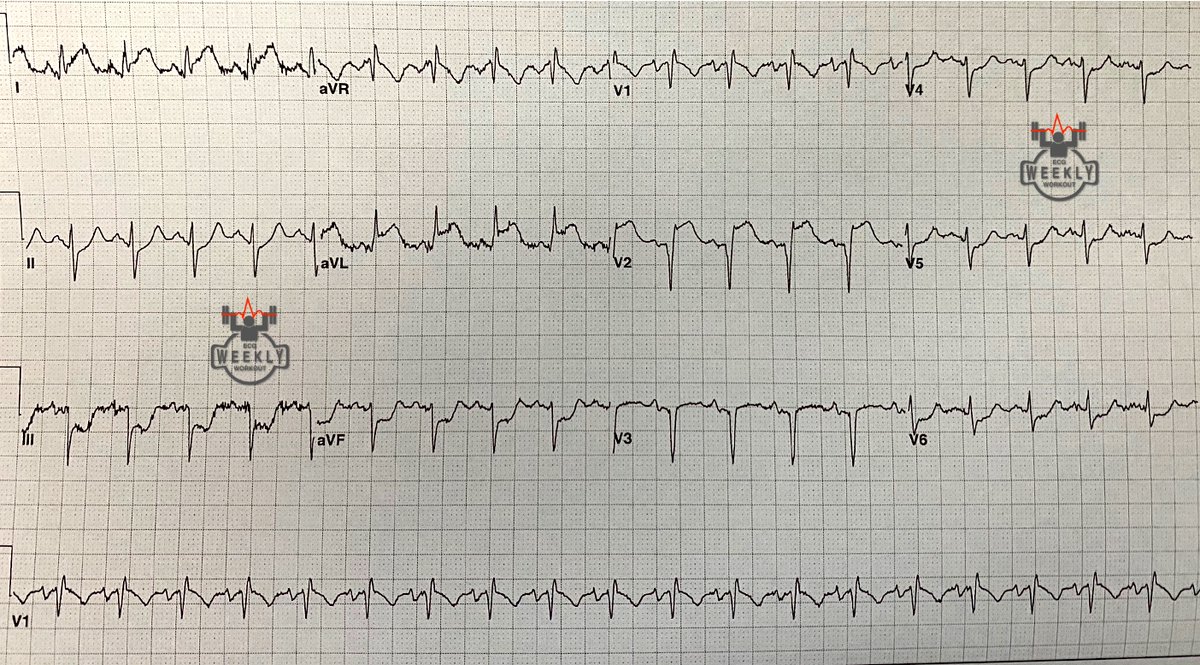 ECGWeekly's tweet photo. A 69-year-old man with history of bilateral lung transplant presents to the ED with severe chest pressure. Symptoms are associated with nausea, sweating, SOB, and dry cough x 4 d. The following ECG is obtained: https://t.co/uzpJLjNCgP https://t.co/uANASgEu3g