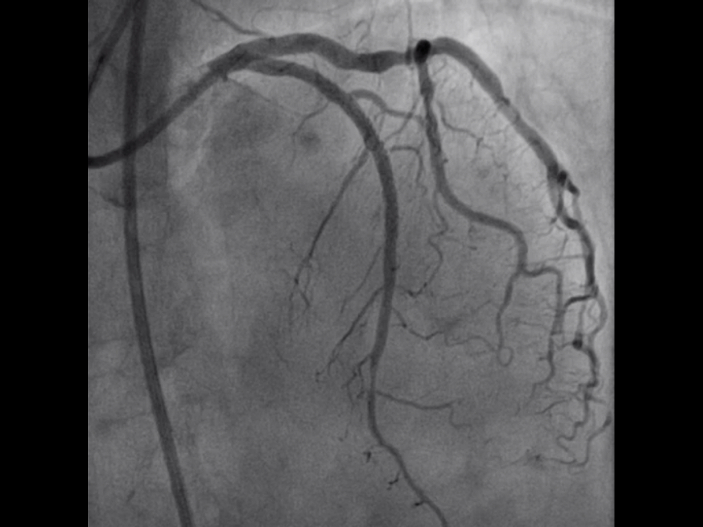 jacorne5's tweet photo. LAD subocclusive stenosis. Angioplasty was done at @INC_CathLab Pre-dilatation with 2.00x15mm semi-compliant balloon. A 2.50x38mm Everolimus-eluting stent was placed and post-dilated https://t.co/YtAyMlS8XO