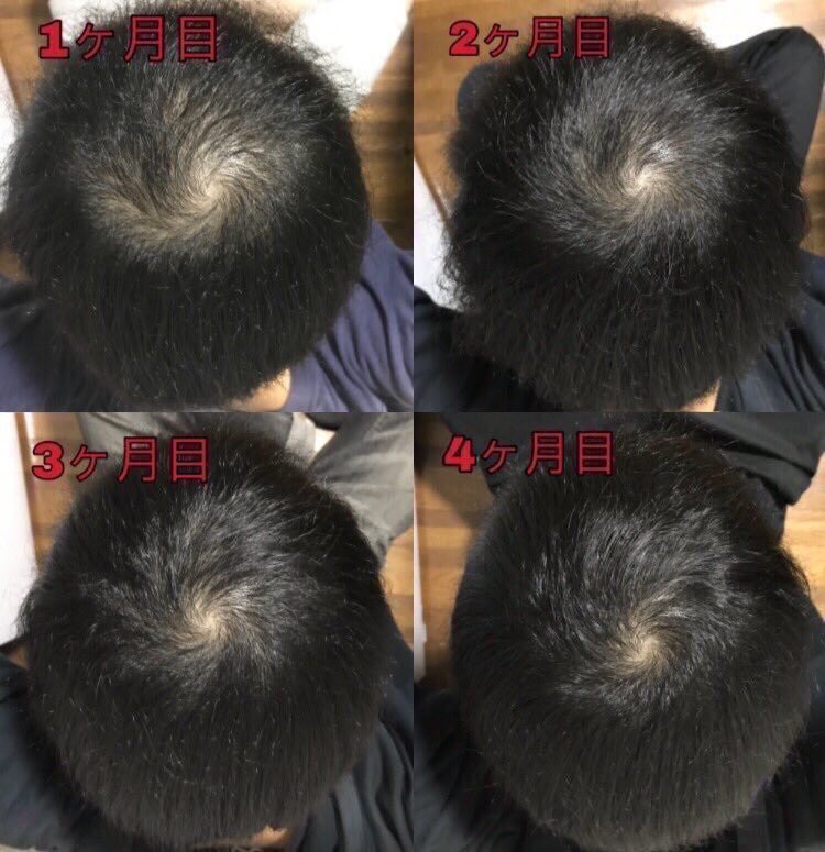 Agaアニキ 頭頂部 21ヶ月分 Aga ハゲ 若ハゲ Aga治療 薄毛 薄毛対策 薄毛改善