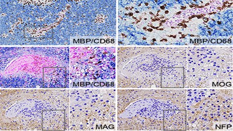 Takai et al. reveal perivenous inflammatory demyelination with MOG-dominant myelin loss in biopsies from patients with MOG antibody-associated disease. The pathological features are distinct from those of MS and neuromyelitis optica spectrum disorders. bit.ly/3cI6hdX