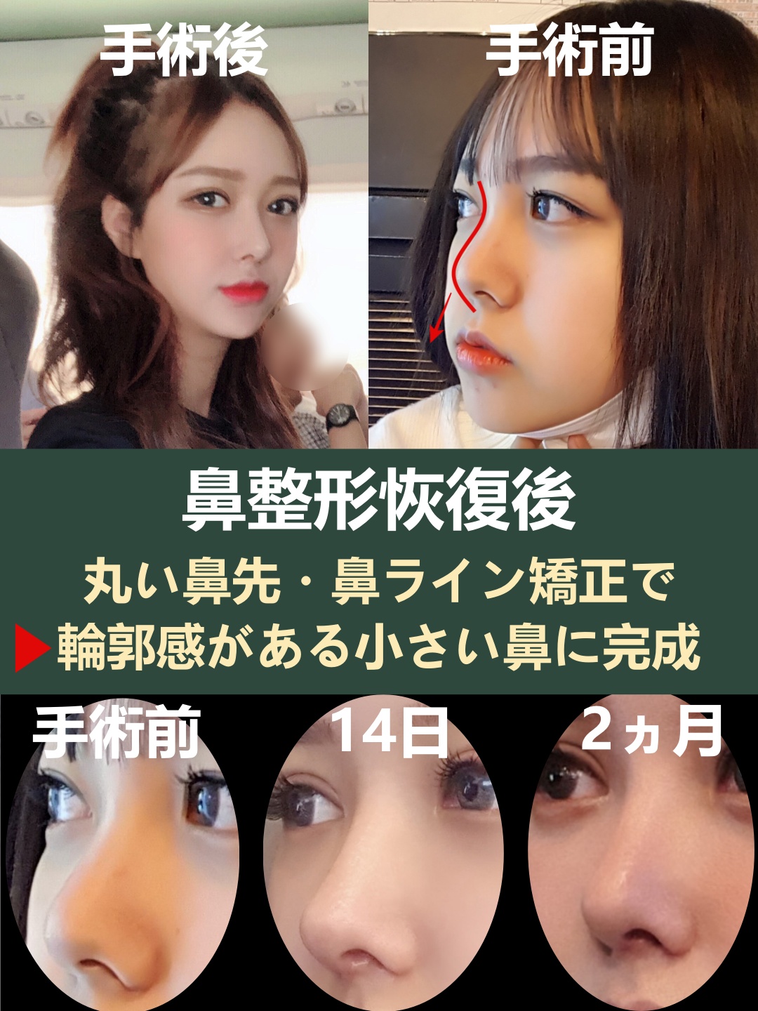 トップフェイス整形外科 日本公式 Topface 鼻整形 でイメージアップ 顔真ん中の鼻の精密な輪郭さで 小顔に Line Topfacejp 団子鼻矯正 小鼻 鼻尖矯正 半直線鼻 韓国整形 鼻柱整形 T Co Uzpakuqeey Twitter