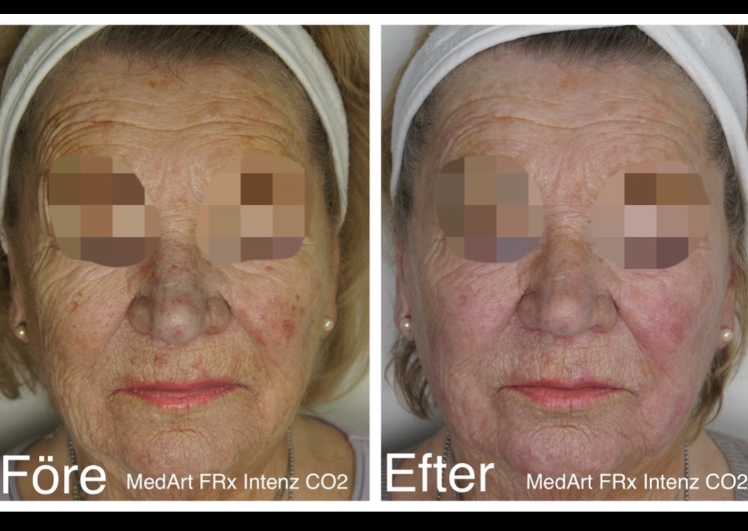 a_medart's tweet photo. Only One Treatment / Full face Fractional CO2 for age spots by MedArt FRx Intenz CO2 @doctorryskinclinic 🥰👍 
Danish Laser Manufacturing https://t.co/gE6pJKJv9Q 

Read More: https://t.co/UGp7TxwGIv

#sundamagedskin #agespots #fractionalco2laser https://t.co/lFQmgW4ff4