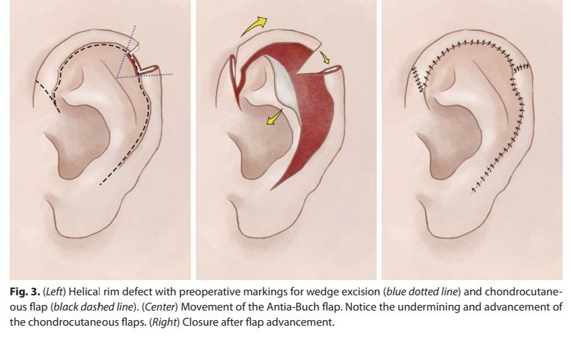MedSyncLtd's tweet photo. A well illustrated paper on ear reconstruction @drjamesthornton for the #reconchallenge. Thank you for sharing !
1/2 https://t.co/ztOcLCxN7o
