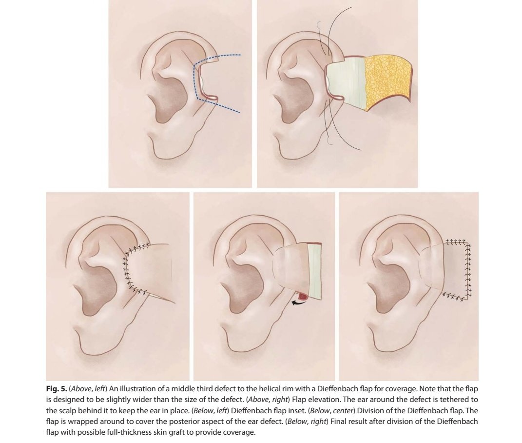 MedSyncLtd's tweet photo. A well illustrated paper on ear reconstruction @drjamesthornton for the #reconchallenge. Thank you for sharing !
1/2 https://t.co/ztOcLCxN7o