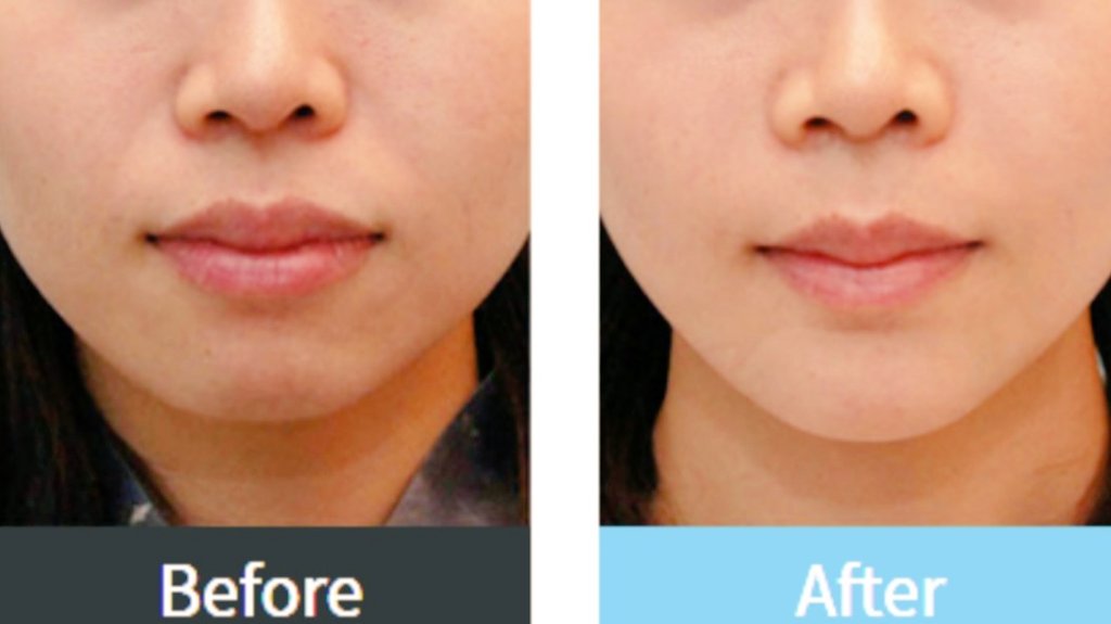 SoonplusJ's tweet photo. ほうれい線を気にしている方は多いのではないでしょうか⁉️
ほうれい線を半永久的に消すことが
できる貴族手術🐣
ブログでも詳しくUP!❣
#soonplus #スーンプラス #貴族手術
#童顔手術 #若返り効果 #老け顔 #韓国整形外科 #韓国美容整形 #目整形 #鼻整形 #脂肪吸引 #毛髪移植 #ソウル https://t.co/BP26mySgtk