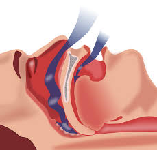 ENTcongress's tweet photo. Obstructive sleep apnea, a risk factor for cardiovascular and microvascular disease in patients with type 2 diabetes: Findings from a population-based cohort study.

Find more updates at ENT Surgery, visit us at https://t.co/FmGMFv1A2o

#entconference #entupdate #entresearchers https://t.co/TFqcpyMVD6