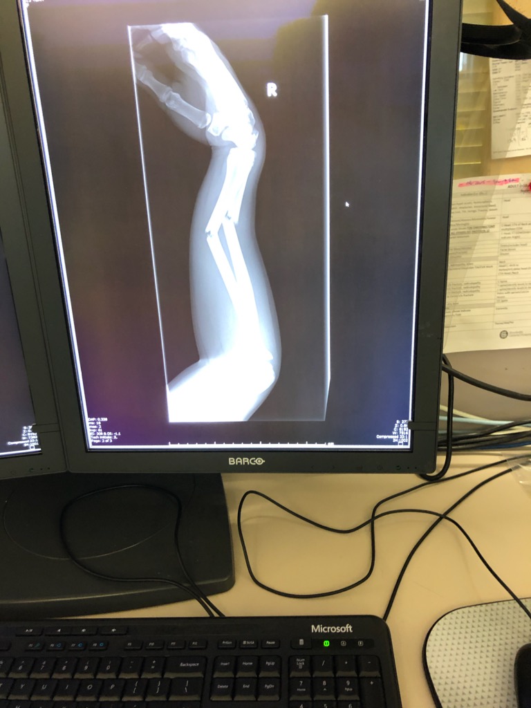Tough start to the summer for my daughter Grace! #PlayAtHome