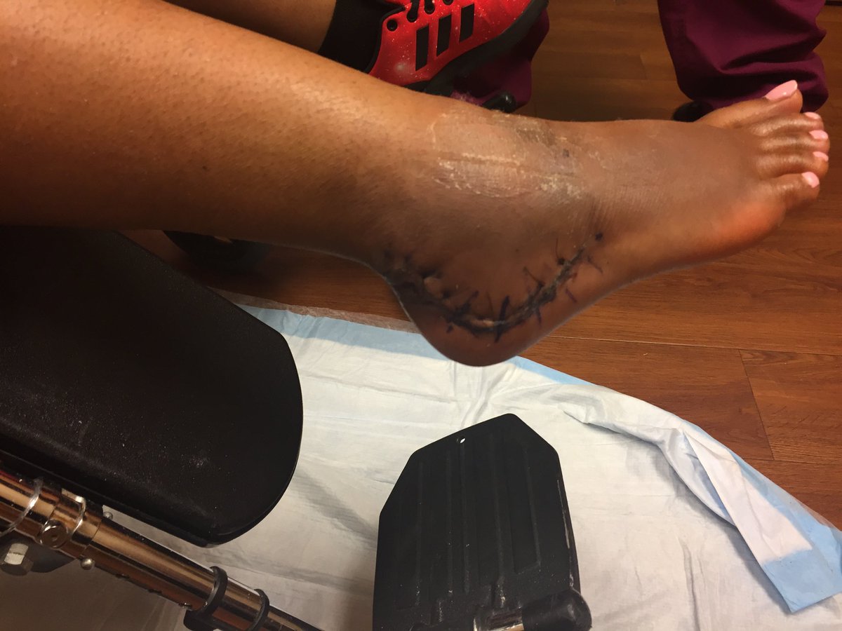 MissEshaAleah's tweet photo. 3 years ago today. #BlessedAndGrateful #BionicFoot https://t.co/LFGgUrR5D5