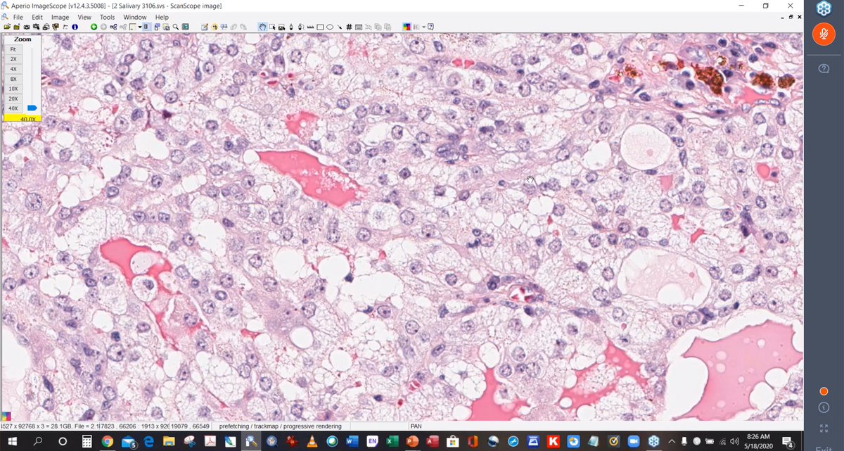Nice use of whole slide imaging in Salivary Gland Virtual Lecture by Lester Thompson. He's pulling out all the stops; a master presenter. @HeadandNeckPat #CAPVirtualPath @KMirza @CArnold_GI @Sara_Jiang