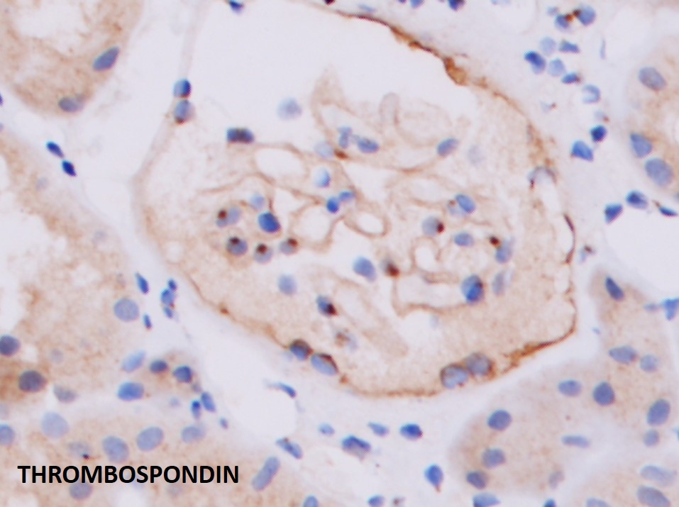 draalok's tweet image. #renalpath #twitterPath #IHC #histopathology #pathology #thrombospondin The perinuclear "dot" positivity for Thrombospondin in normal visceral epithelial cell cytoplasm.. serves a good internal control to check adequacy of staining!!