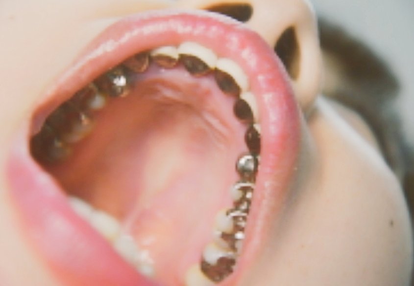 歯ーベスト 素晴らしい口内ですね 銀歯虫歯を恥ずかしがる女性は多いですが 歯フェチからしたら魅力ある女性です